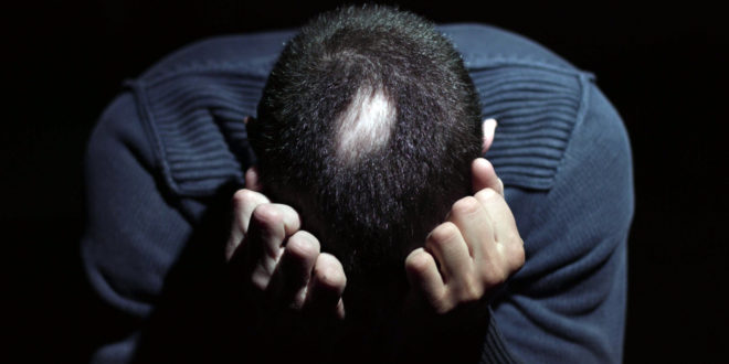 problemi di alopecia